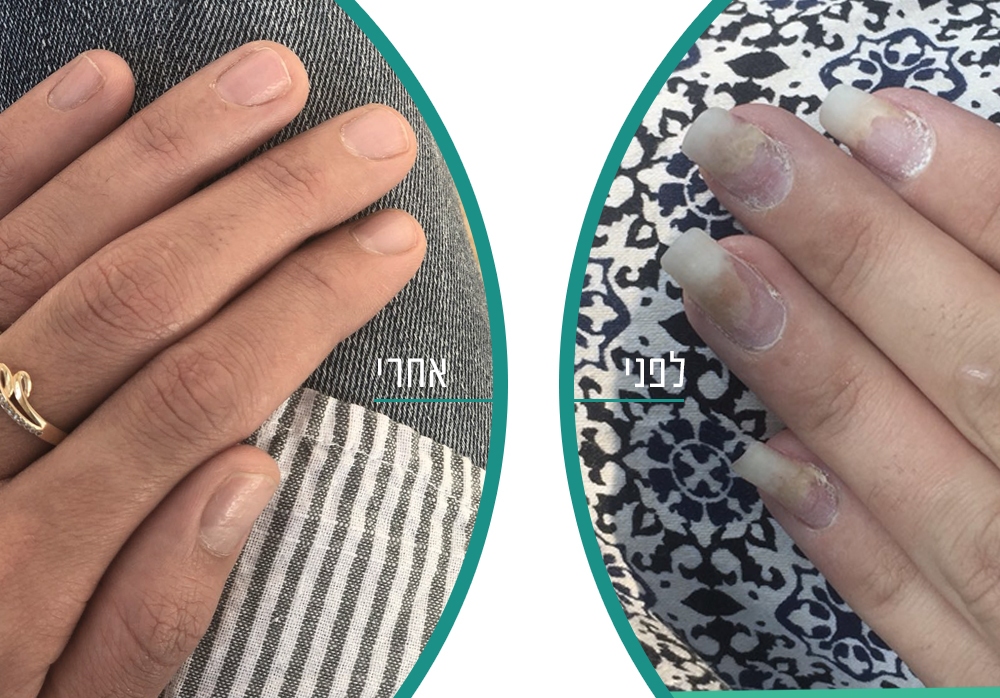 לפני ואחרי טיפול בפטרת ציפורניים