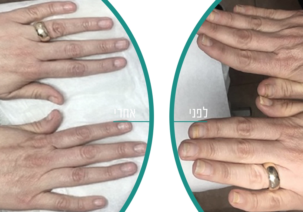 לפני ואחרי טיפול בפטרת ציפורניים