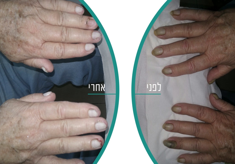 לפני ואחרי טיפול בפטרת ציפורניים