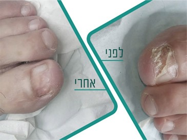 טיפול בלייזר בפטרת ציפורניים