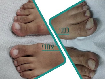 תמונת לפני ואחרי פטרת ציפורניים