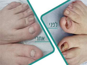 טיפול בפטרת בעזרת לייזר קליניקה כרמל